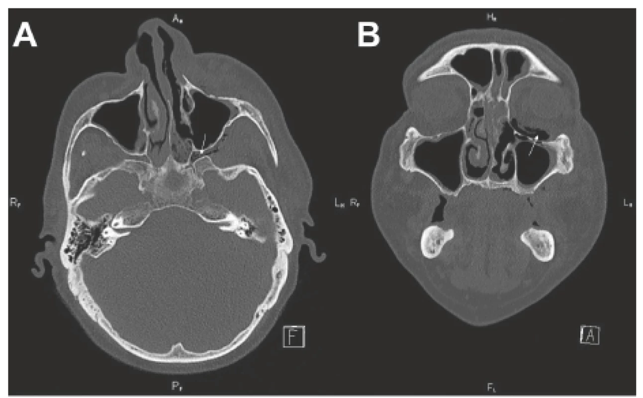 CT vedlejších nosních dutin - předoperačně před radikálním
chirurgickým resekčním výkonem.<br>
A-axiální projekce (infiltrace fossa pterygopalatina vlevo - viz šipka);
B-koronární projekce (pneumoorbita - viz šipka)