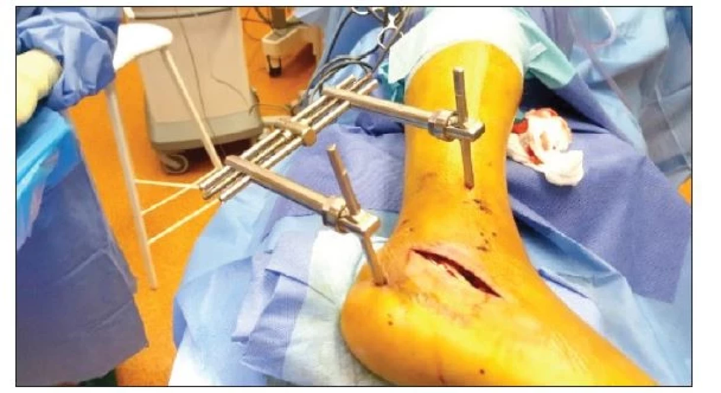 K zavedení patního distraktoru je nutné umístit Schanzův šroub
do tuber calcanea a do distální tibie z laterální strany. Změnou úhlu
Schanzova šroubu, následnou distrakcí lze korigovat správnou osu,
délku a výšku patní kosti. Tím je i jednodušší repozice dislokovaných
fragmentů zadní kloubní plochy a přístup do subtalárního kloubu je
snadnější