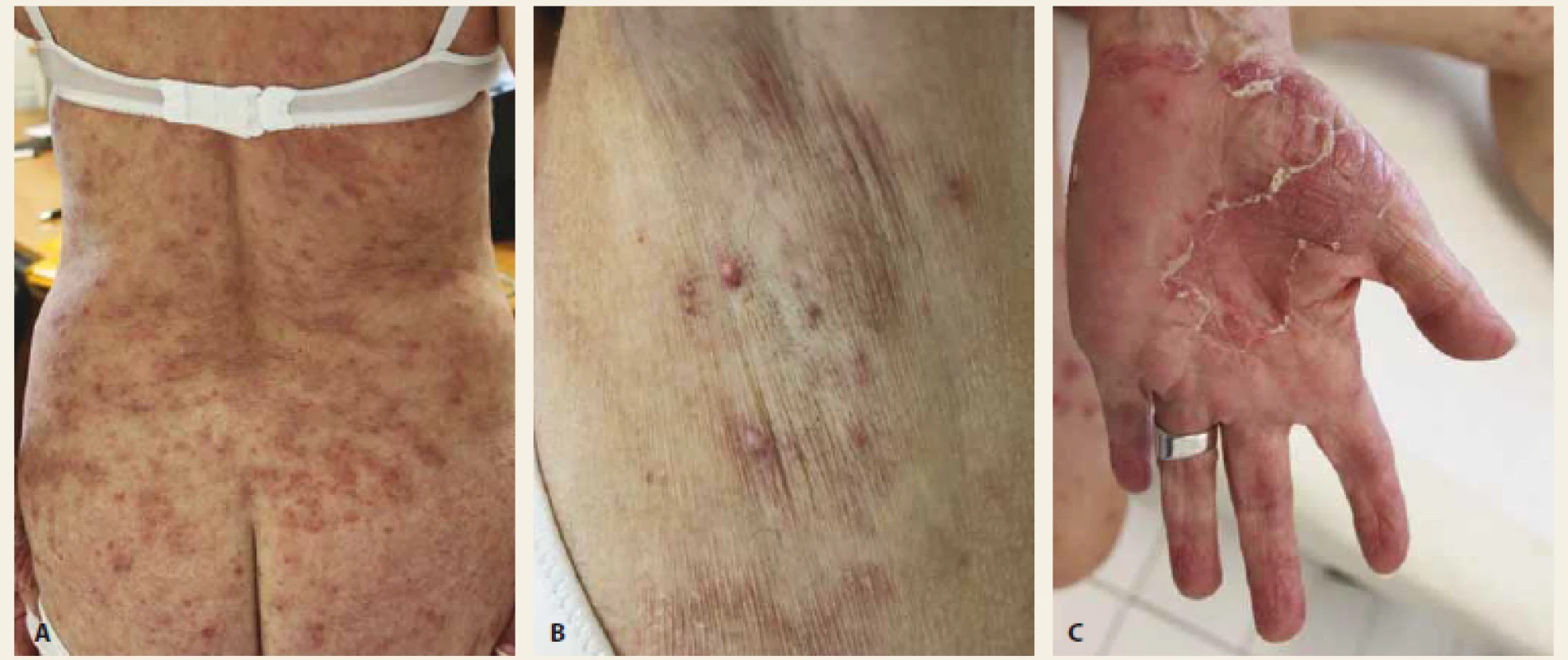 A – Prejavy guttátnej psoriázy; B – prejavy hidradenitis suppurativa; C – palmoplantárna pustulózna psoriáza
(18. 10. 2018).<br>
Fig. 2. A – Guttate psoriasis; B – manifestations of hidradenitis suppurativa; C – palmoplantar pustular psoriasis
(18th of October 2018).