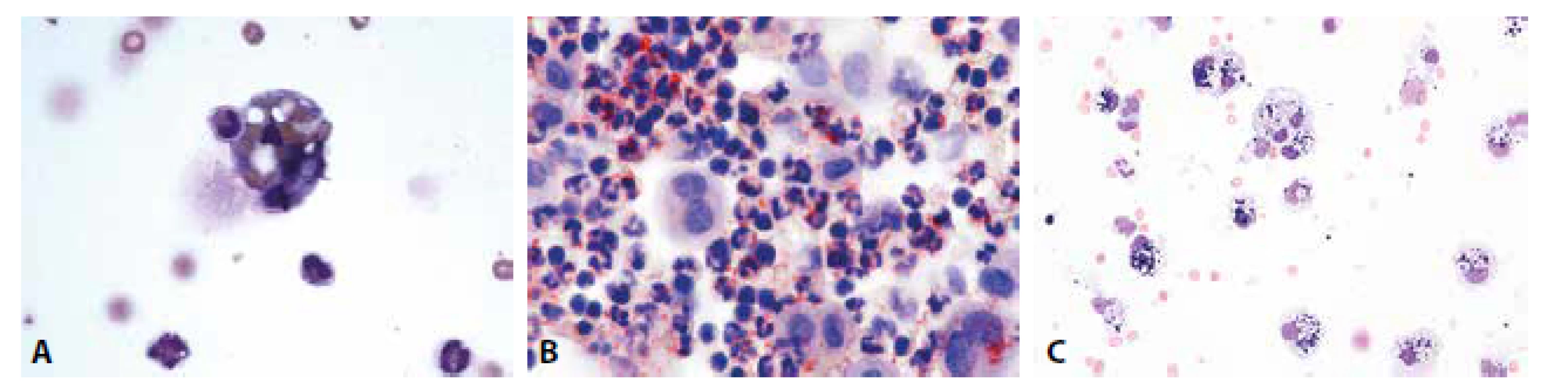 (A) Erytrofygocytóza v rámci tkáňové léze. V cytoplazmě makrofága zčásti odbarvené erytrocyty. Neutrofilní granulocyt jako známka tkáňové léze ve fázi
iniciálního pohlcení. (B) Úklidová reakce v barvení olejovou červení. Dystrofické steatóza neutrofilních granulocytů, pozitivita lipidů v cytoplazmě makrofágů.
(C) Úklidová reakce posthemoragická. Makrofágy s železitým pigmentem. MGG, 400.
