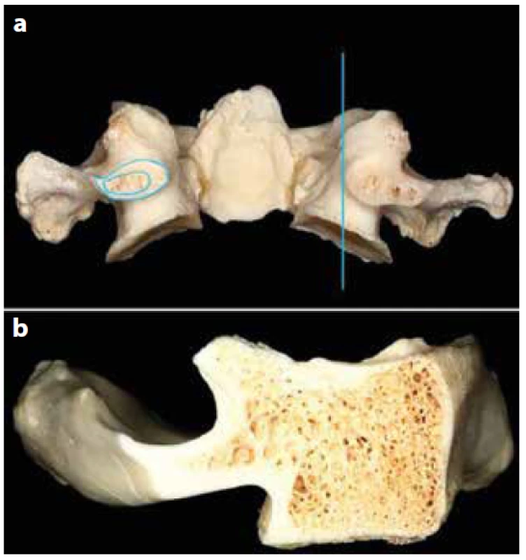 Řez anatomickým preparátem atlasu, oblastí jeho
zadní inzerce, popisuje přítomnost spongióozní kosti
v koronární (a) a parasagitální (b) rovině<br>
Fig. 3. Sections of the insertion of the posterior arch of
atlas in the coronal (a) and parasagittal (b) planes illustrate
the presence of cancelous bone