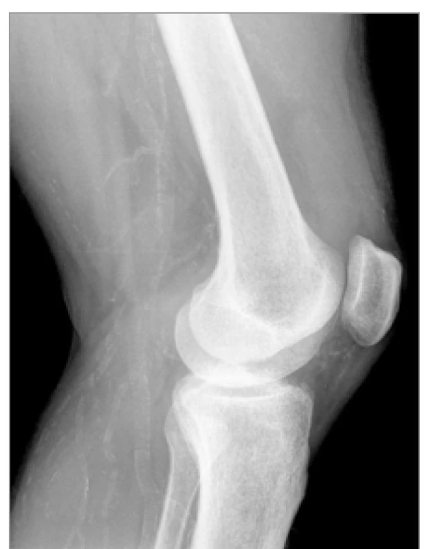 Rentgenologický snímek jednoho
(levého) kolenního kloubu před
úrazem<br>
Fig. 1. Lateral radiography of left knee
before injury