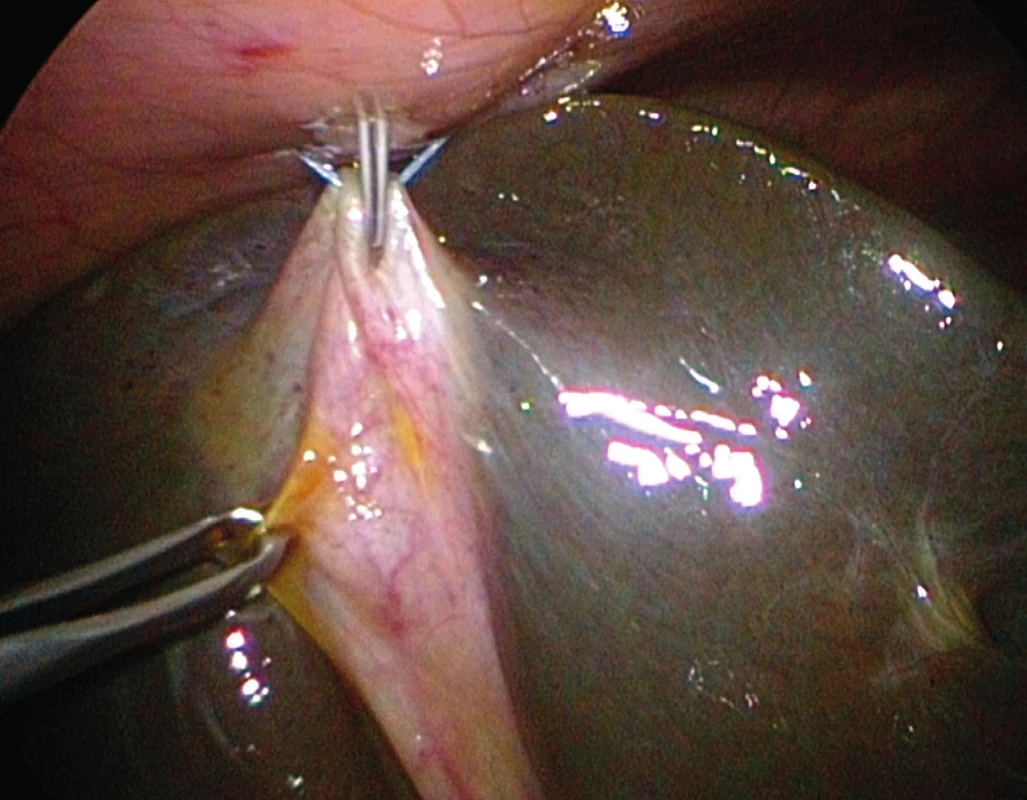 Laparoskopická cholangiografia, hypoplastický žlčník
je fixovaný stehom ku prednej brušnej stene, kanyla je
zavedená do žlčníka transparietálne.<br>
Fig. 5. Laparoscopic cholangiography, the hypoplastic gall
bladder is fixed by stich to the anterior abdominal
wall, the cannula is inserted into the gallbladder
transparietally.