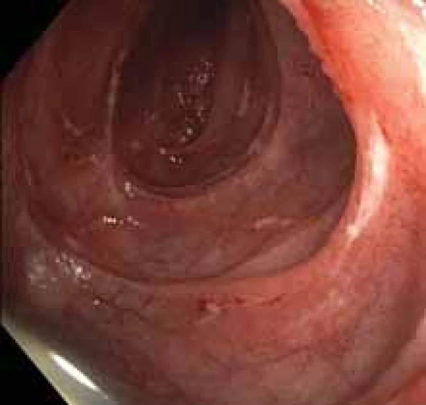 Mnohočetné ulcerace orálního 
jejuna.
Fig. 2. Multiple ulcerations of oral 
jejunum.
