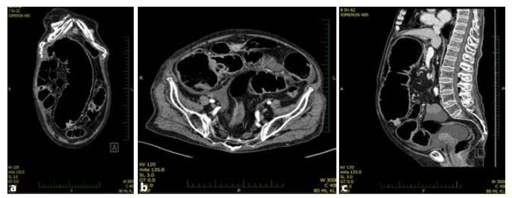 a,b,c: CT nález. Ileózní stav při nádoru c. transversum<br>
Fig. 1a,b,c: CT finding. Large bowel obstruction caused by tumor of transverse colon