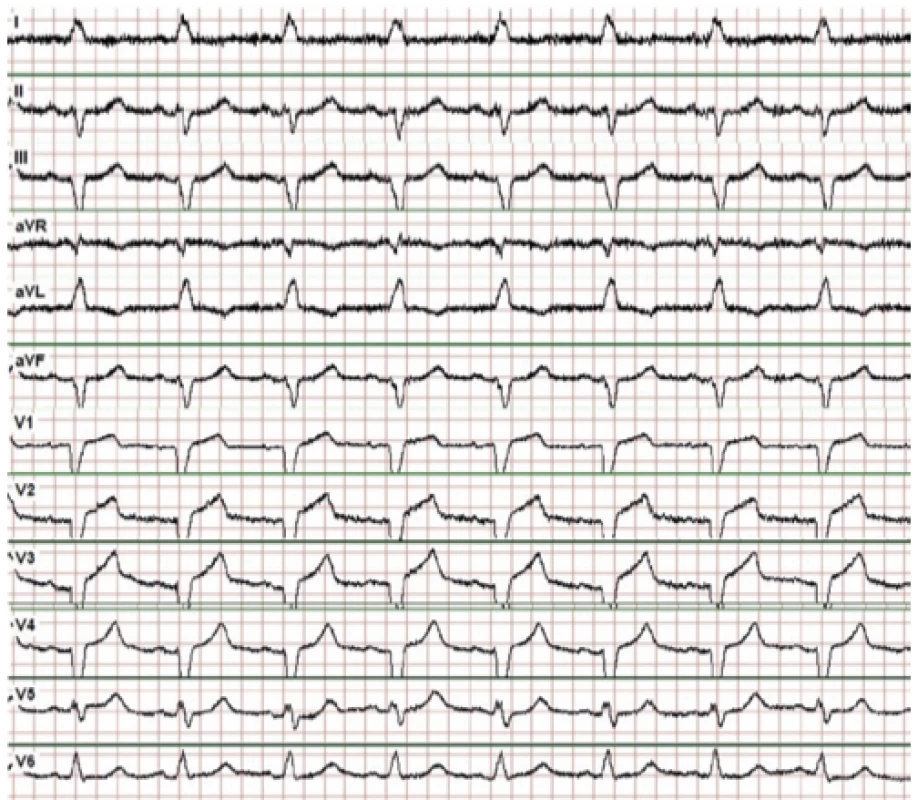 Vstupní EKG s blokem levého Tawarova raménka
