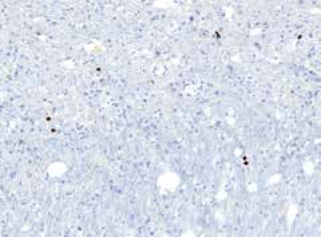 Proliferační marker Ki67 znázorňuje méně
než 1 % buněk. Imunohistochemie Ki67, 20x.