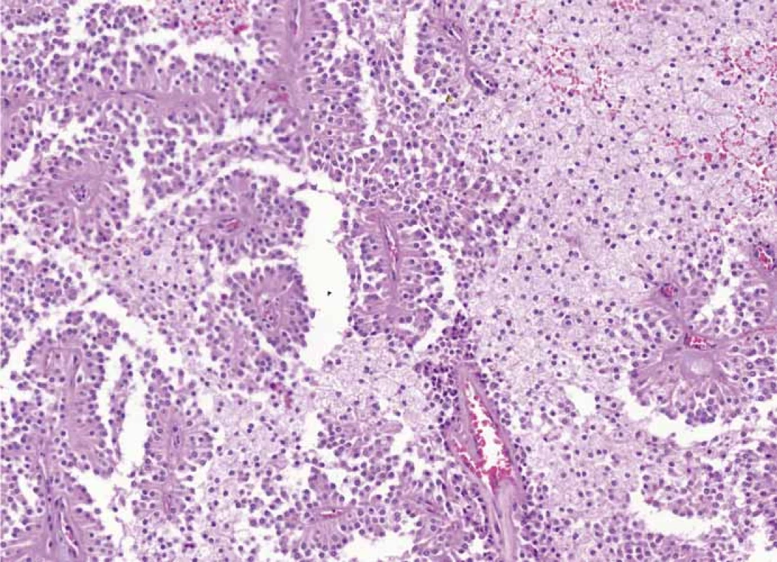 Histologický nález – barvení hematoxylin-eozin.