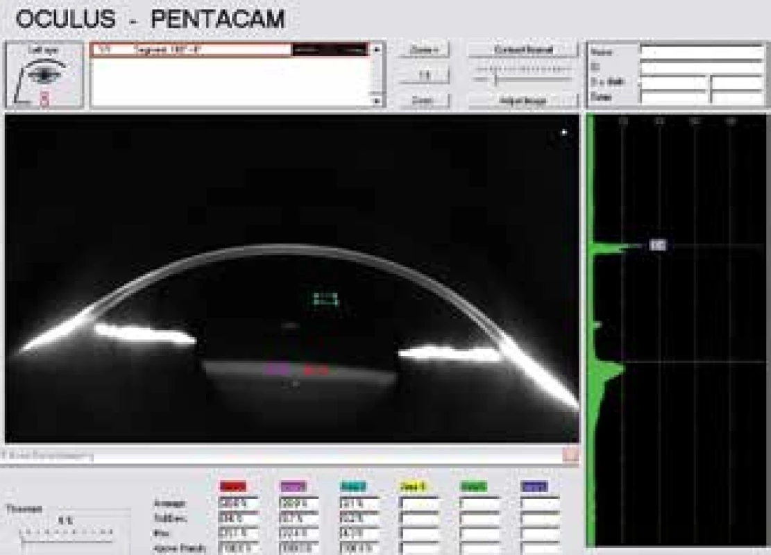 Scheimpflug photograph. Measurement of relative
opacity (in %) in two fields in the IOL material in cross-section
(0° to 180°) at second follow-up after ten years. The
isoline was set as opacity in an optically empty anterior
chamber above the anterior surface of the IOL
