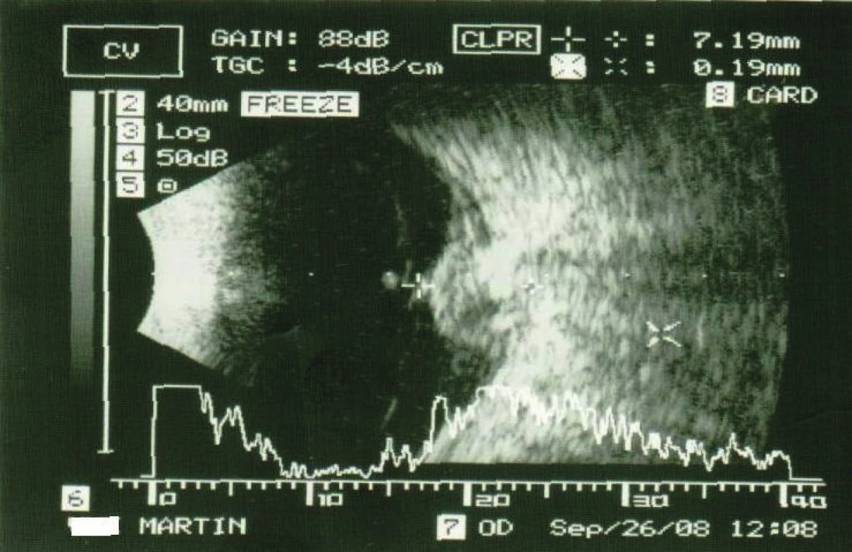 Ultrasound image of tumour deposit above disc of
optic nerve in 2008
