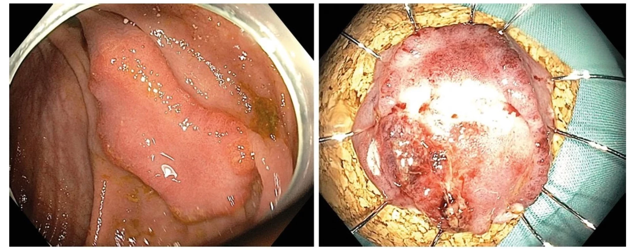 Neoplastická léze cékoascendentního přechodu u nemocného s vysokým operačním rizikem (vlevo), resekát po endoskopické transmurální resekci
(FTR) našpendlený na korkovou podložku, histologicky R0 resekce G1 adenokarcinomu s povrchovou submukózní invazí (sm1) bez dalších rizikových známek
