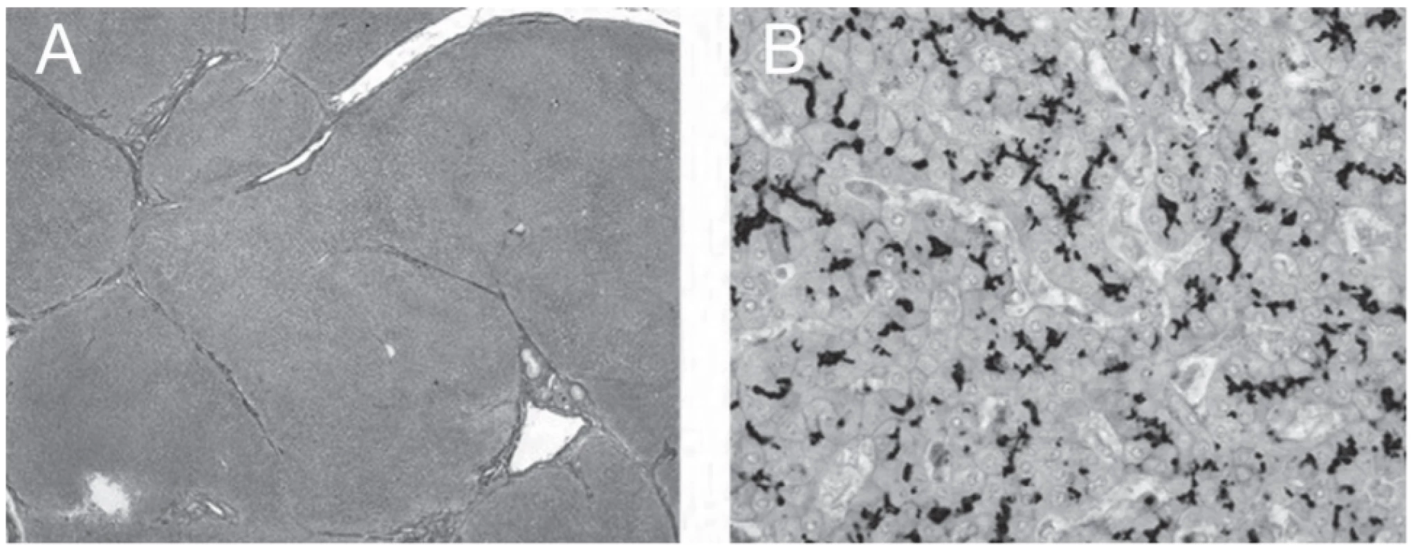 Explanted liver; septal fibrosis (A) and preserved immunohistochemical expression of BSEP along bile canaliculi (B).
(A) Verhoeff’s van Gieson, original magnification x40. (B) Rabbit polyclonal anti-BSEP primary antibody (NBP1-89319, Novus
Biologicals, Abingdon, UK), hematoxylin counterstain; original magnification x400.