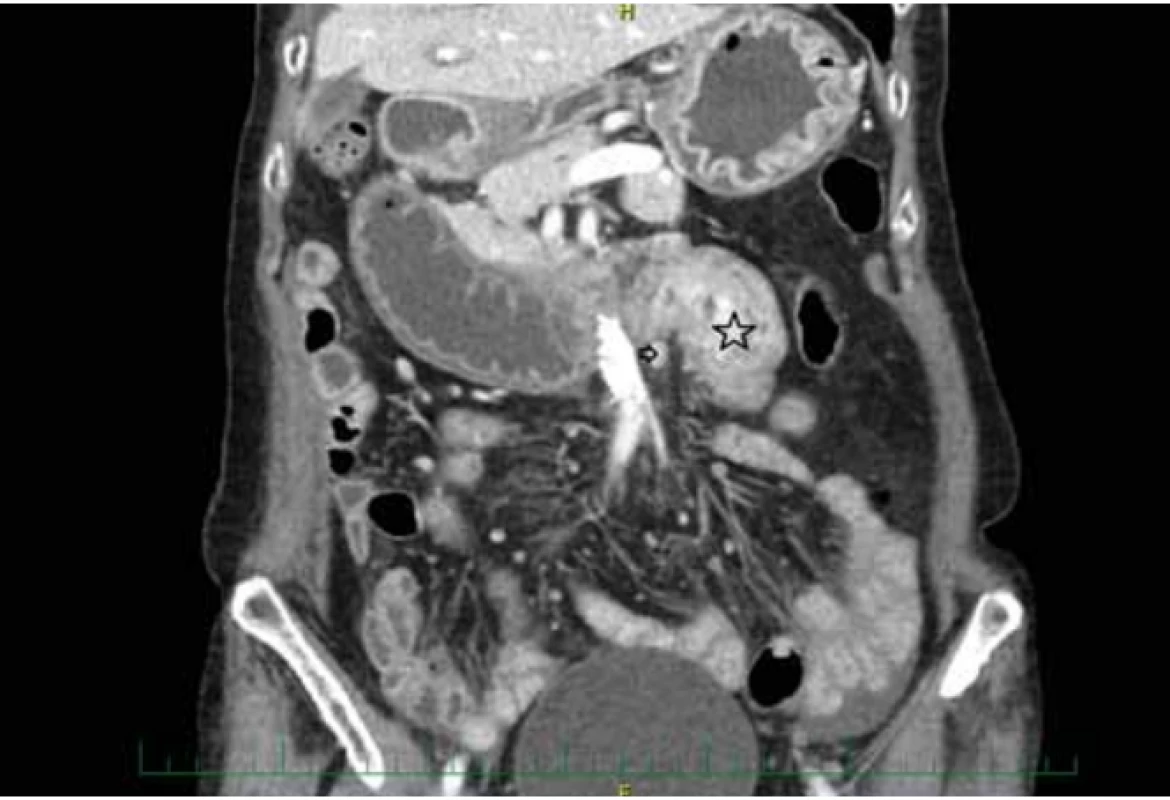 CT koronární obraz tumoru tenkého střeva (hvězdička) a onkosuspektních lymfatických uzlin (šipka).
Fig. 1. CT image of small bowel tumor (asterisk) and oncosuspect lymph nodes
(arrow).<br>