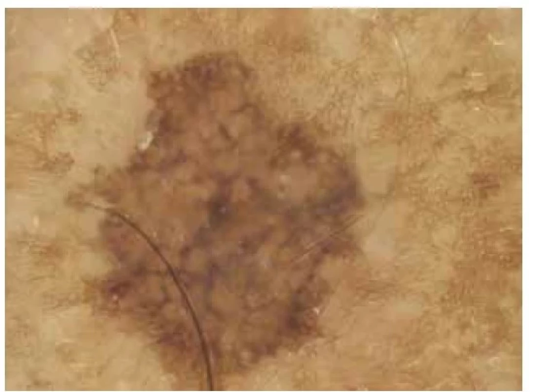 Seboroická veruka*<br>
Dermatoskopicky pravidelná léze světle hnědé barvy s nápadně
ostře ohraničenými a někde jakoby „vykousanými“
okraji, hnědé linie v retikulárním uspořádání.