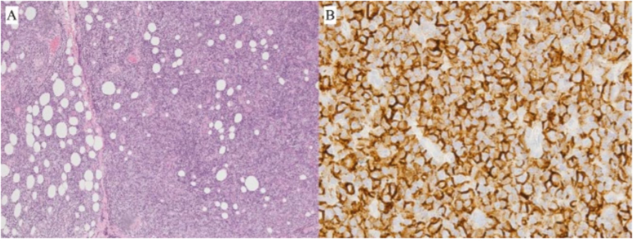 Patient 2 – B-NHL from spectrum of MZBL type malt, biopsy finding:<br>
A) Infiltration of fibrolipomatous conjunctiva with dense, diffuse tumorous lymphoproliferation from<br>
small to medium-sized lymphoid cells (HE, enlargement 100x)<br>
B) Immunohistochemical positivity of CD20+ marker in tumour cells (enlargement 630x)