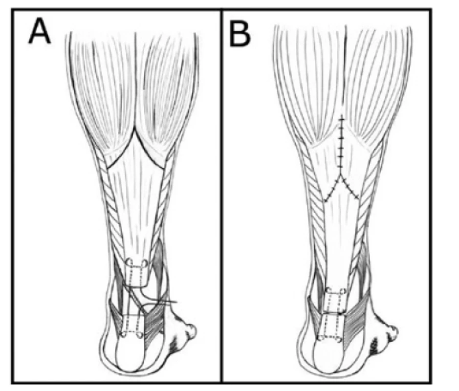 Metody rekonstrukcí defektů Achillovy šlachy: technika
podle Abrahama-Pankowiche − A – příprava, B – dokončení<br>
Fig. 6: Methods of Achilles tendon reconstruction: Abraham-
-Pankowich technique − A – preparation, B – completion