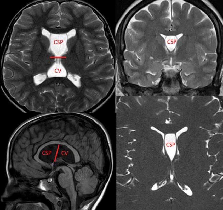 Zobrazení MR cyst CSP a CV ve všech rovinách. Hranice mezi CSP a CV je znázorněna
červenou čárou.
CSP – cavum septi pellucidi; CV – cavum vergae<br>
Fig. 1. MRI of the CSP and CV in all planes. The border between CSP and CV is marked by
a red line.
CSP – cavum septi pellucidi; CV – cavum vergae