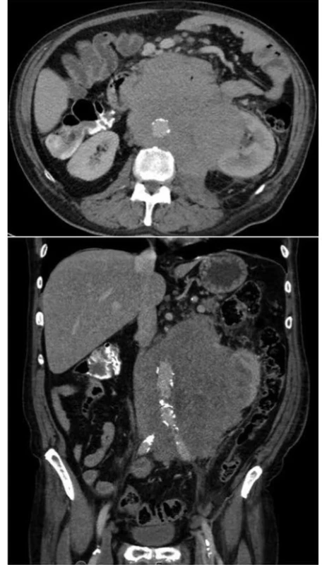 Rozsah postižení dutiny břišní lymfomem<br>
Fig. 3. Extent of tumorous infiltration of patient’s abdomen