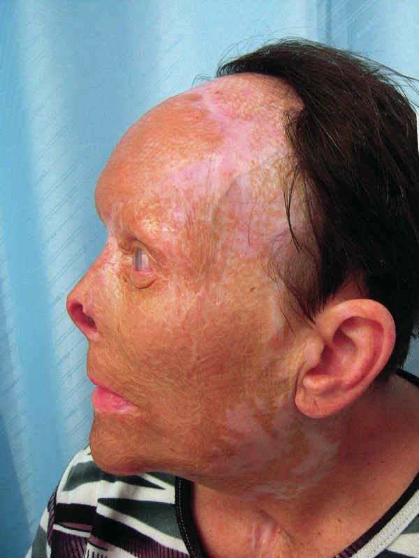 One year after the surgery – side view
