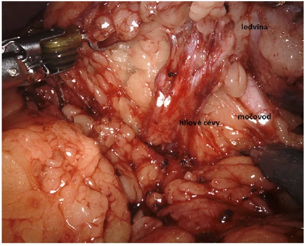 Ledvina a hilus ledviny <BR> 
Fig. 1. Kidney and hilus of the kidney