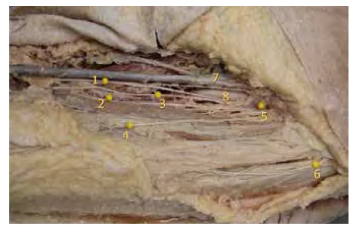 Nervy v trigonu femorale. Anatomický preparát větví femorálního
nervu ve femorálním trojúhelníku a n. cutaneus femoris lateralis.
1. n. saphenus, 2. nerv k m. rectus femoris, 3. nerv k vastus medialis,
4. n. cutaneus femoris anterior, 5. n. femoralis, 6. n. cutaneus femoris, 7. vena
femoralis, 8. arterie femoralis