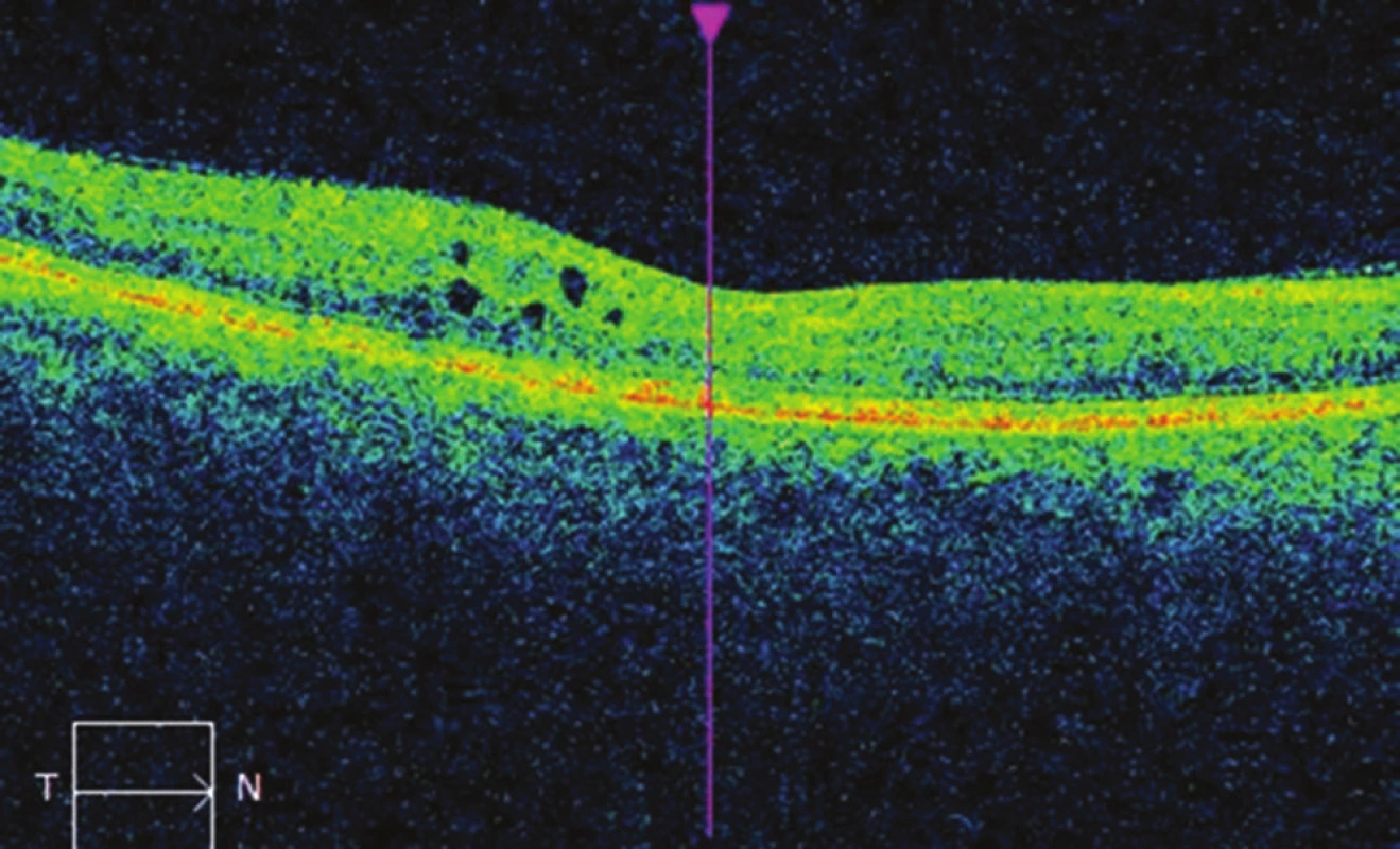 OCT image of right eye after micropulse laser treatment of
the central area: decrease of ocular edema, CRT 266 μm.