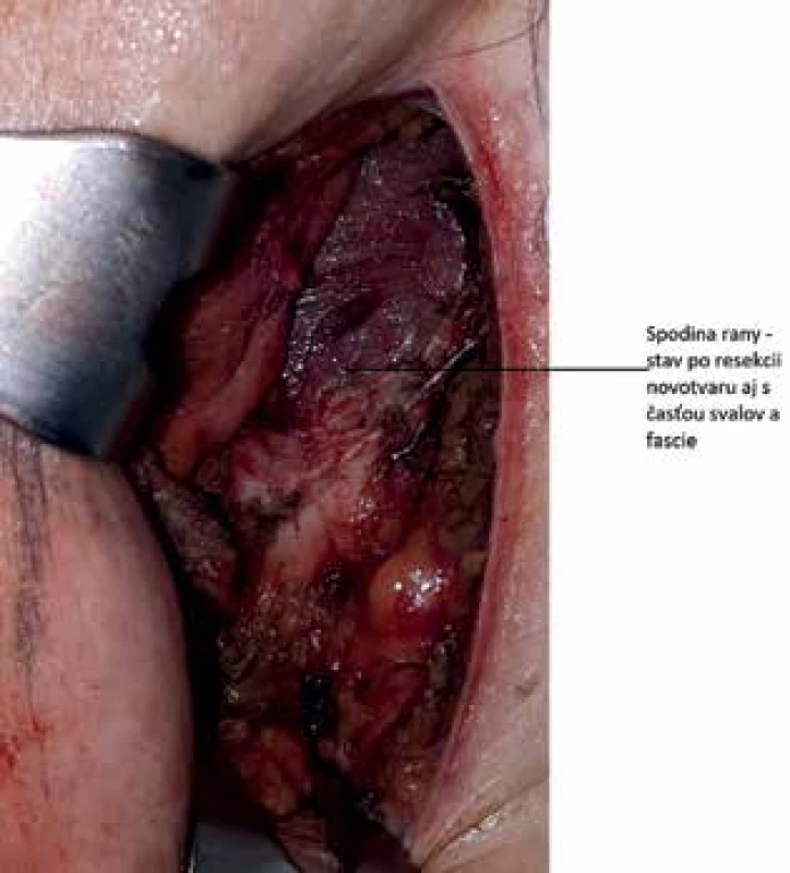 Stav po resekcii tumoru aj s časťou svalovej fascie.<br>
Fig. 3: Wound after tumor resection with part of muscular 
fascia