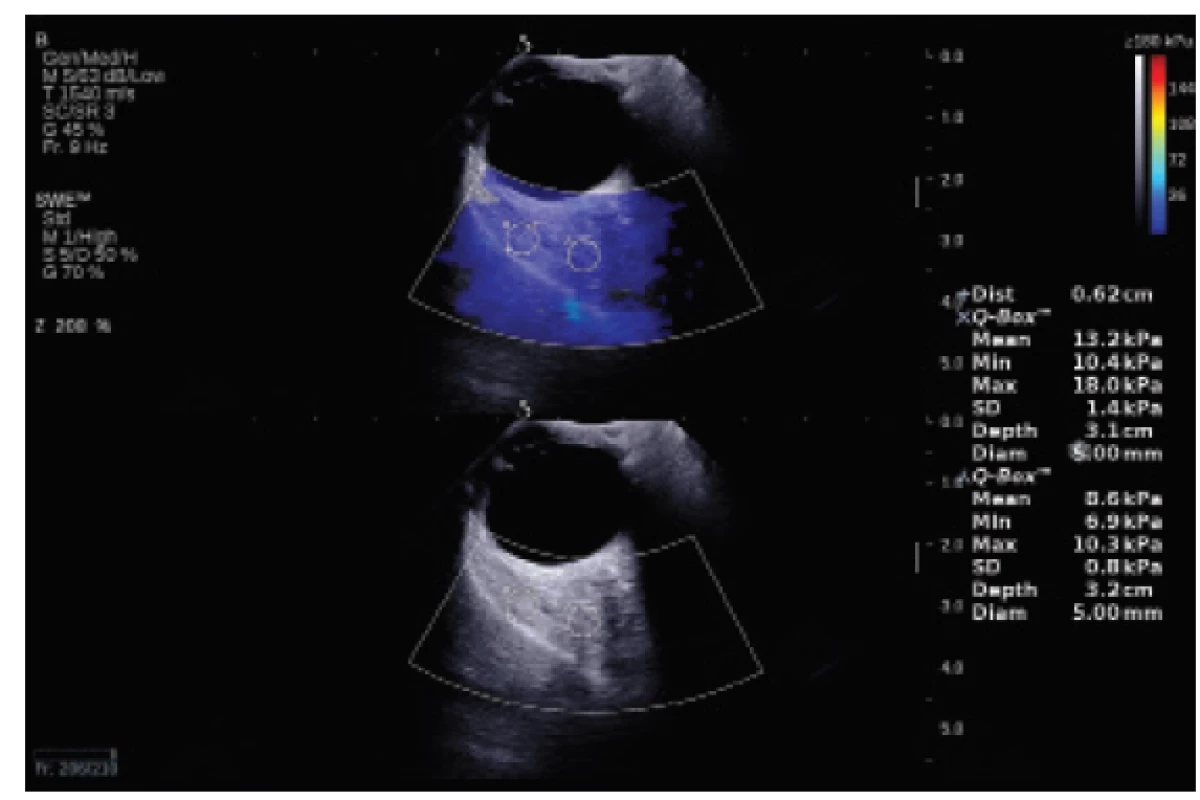 Measurement of elasticity of edematous musculus
rectus superior