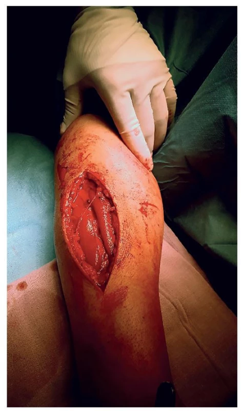 Prolabující svalstvo po započetí incize svalové pochvy<br>
Fig. 1: Muscle prolapse when incising the muscle fascia