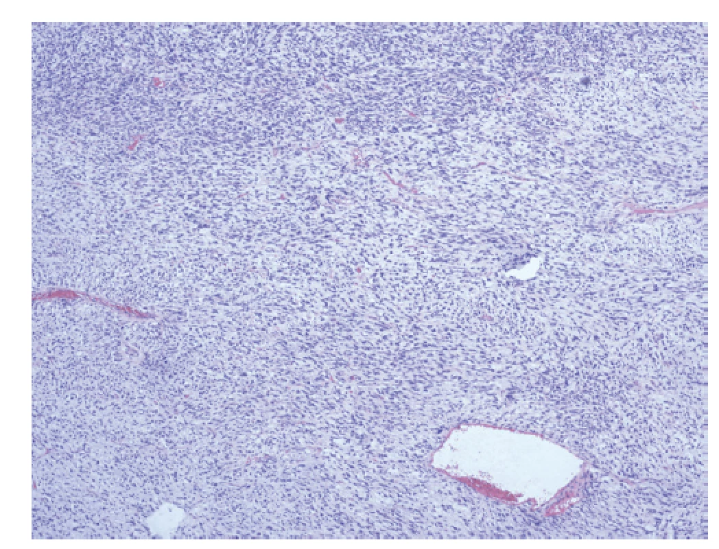 High grade fyloidní nádor, maligní hypocelulární
komponenta s převahou myxoidní matrix.<br>
Fig. 5: High grade phyllodes tumor, malignant hypocellular
component with predominance of myxoid matrix.