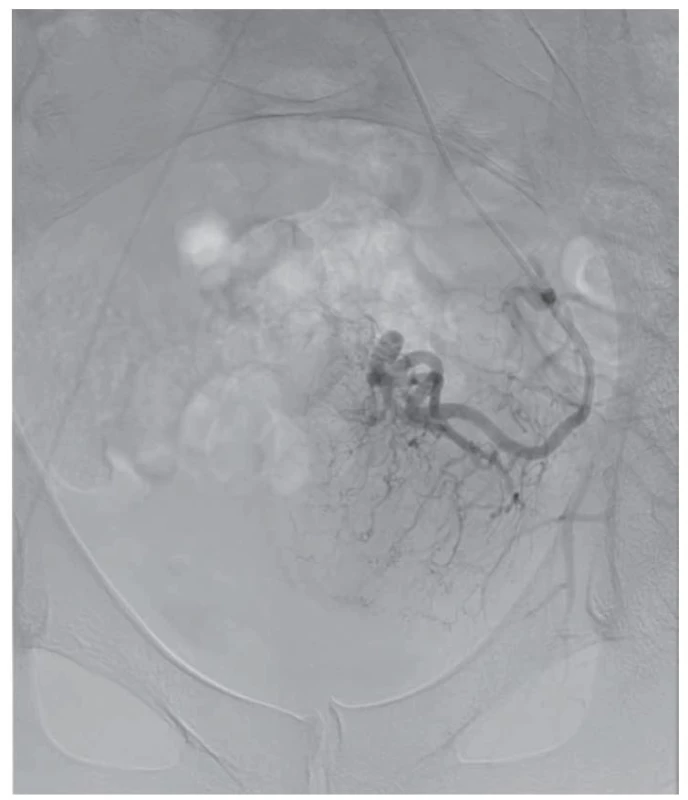 Levá uterinní arterie před UAE.<br>
UAE – embolizace uterinních tepen<br>
Fig. 4. Right uterine artery before UAE.