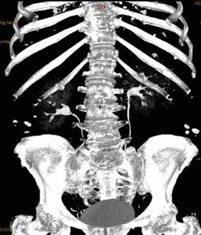 Rekonstrukce CT – vylučovací urografie (chybí náplň kontrastní látkou v horním kalichu pravé ledviny) <br>
Fig. 6: CT reconstruction – excretory urography (absent
contrast agent filling in the upper calyx of the right kidney)