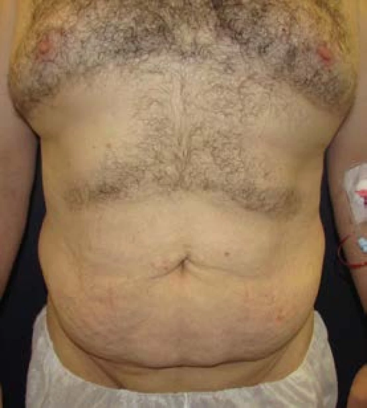 Lower body lifting, 45letý pacient po redukci hmotnosti
o 50 kg pod vedením obezitologa bez bariatrické léčby
– pohled zepředu předoperačně