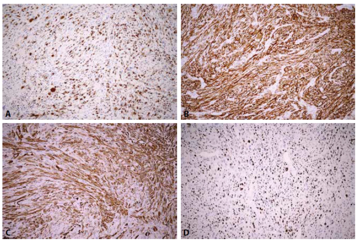 Immunohistochemical staining of atypical fibroxanthoma. A. Diffuse strong cytoplasmic CD68 positivity. B Diffuse strong cytoplasmic
CD10 positivity. C. Diffuse strong cytoplasmic SMA positivity. D. Ki-67 positivity in approximately 50% of nuclei. DAB, original magnification x200.