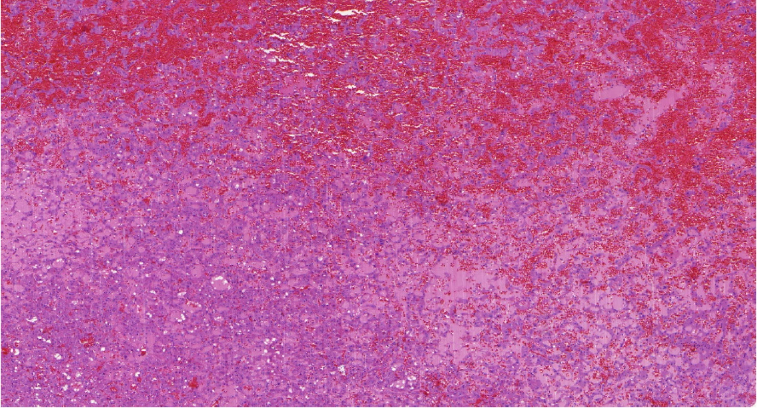 LOT (low-grade oncocytic tumor) je nádor, který
vykazuje abnormality v MTOR pathway<br>
Fig. 6. LOT (low-grade oncocytic tumor) is tumor
with abnormalities in MTOR pathway