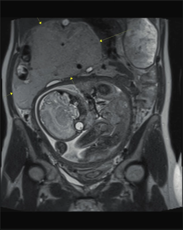 MRI dutiny břišní: předoperační rozsah angiomyolipomu,
v porovnání s velikostí dělohy [6]