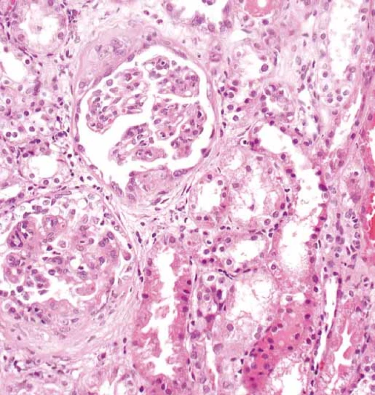 Glomeruly s rozšířenými mezangiálními oblastmi.
V obou glomerulech jsou segmentární projevy sklerotizace
s adhezemi fibroepitelovým srpkům (šipka). Současně
vpravo je erytrocytární válec v lumen tubulu (hematocyklin
a eozin).<br>
Fig. 2. Glomeruli with extended mesangial regions. There
are segmental manifestations of sclerotization with adhesions
to fibroepithelial crescents (arrow) in both glomeruli.
The erythro cyte cylinder is in the tubular lumen (hematocyklin
and eosin) at the same time.