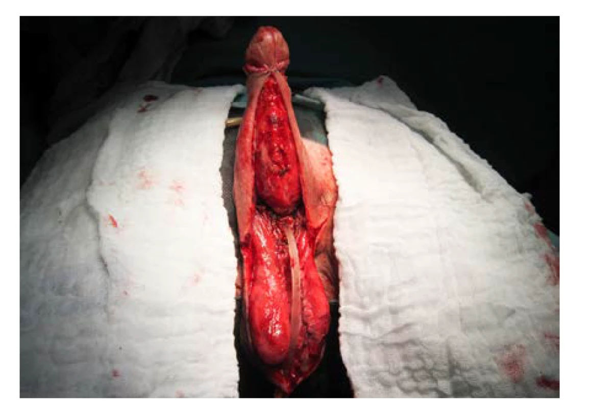 Fixace laloků pod corona glandis, stav před
suturou na ventrální straně penisu<br>
Fig. 8. Flap fixation under the corona of glans penis;
the state prior to suturing at the ventral side of the
penis