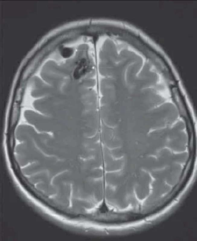 MRI snímek mozku pacientky s hereditární hemoragickou teleangiektázií, snímek v axiální rovině vpravo frontálně paramediálně je přítomna arteriovenózní malformace o průměru kolem 20 mm.