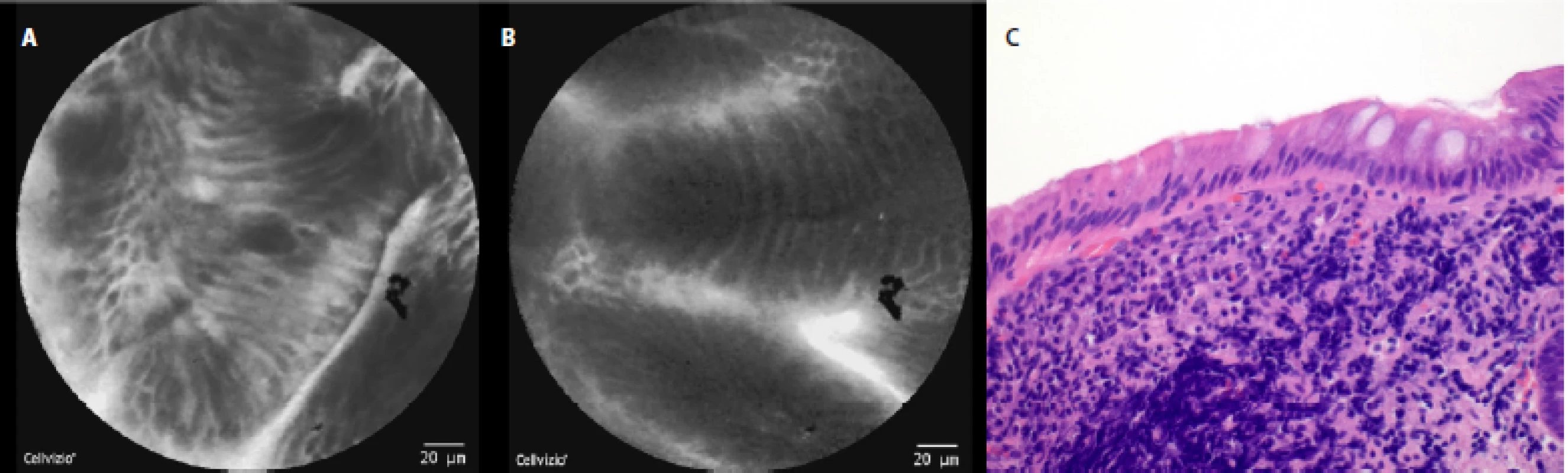 pCLE view of BE with intestinal metaplasia (nondysplastic): a – columnar cells with dark “goblet” cells, no nuclear atypia, b – columnar cells without nuclear atypia; c – histopathology examination: columnar epithelium of intestinal type with goblet cells, haematoxylin-eosin staining 40×
