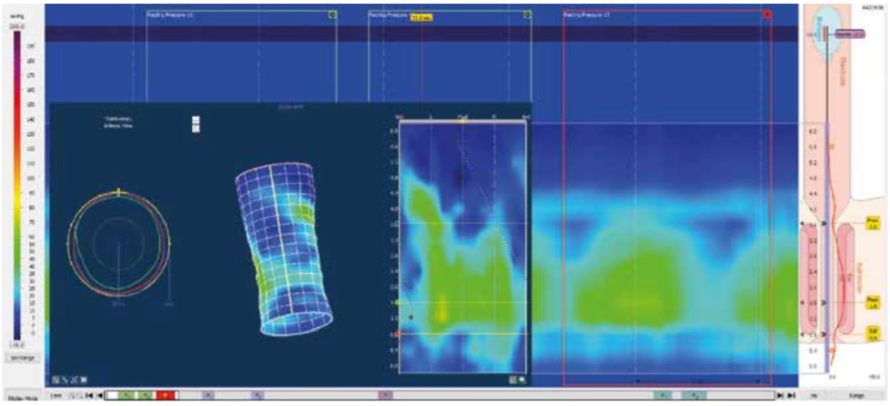 Klidový tonus
Zdroj: Archiv oddělení gastrointestinální endoskopie, Ústřední vojenská nemocnice − Vojenská fakultní nemocnice, Praha<br>
Fig. 6: Resting pressure
Source: Department of Gastrointestinal Endoscopy archive, Military University Hospital, Prague