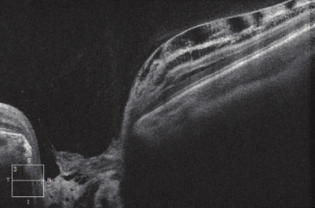 HD-OCT: Linear horizontal transpapillary scan of right
eye, extensive ODP covered by hyperreflective tissue.
Nasally image of schisis-like retinopathy, with separation
of individual retinal layers