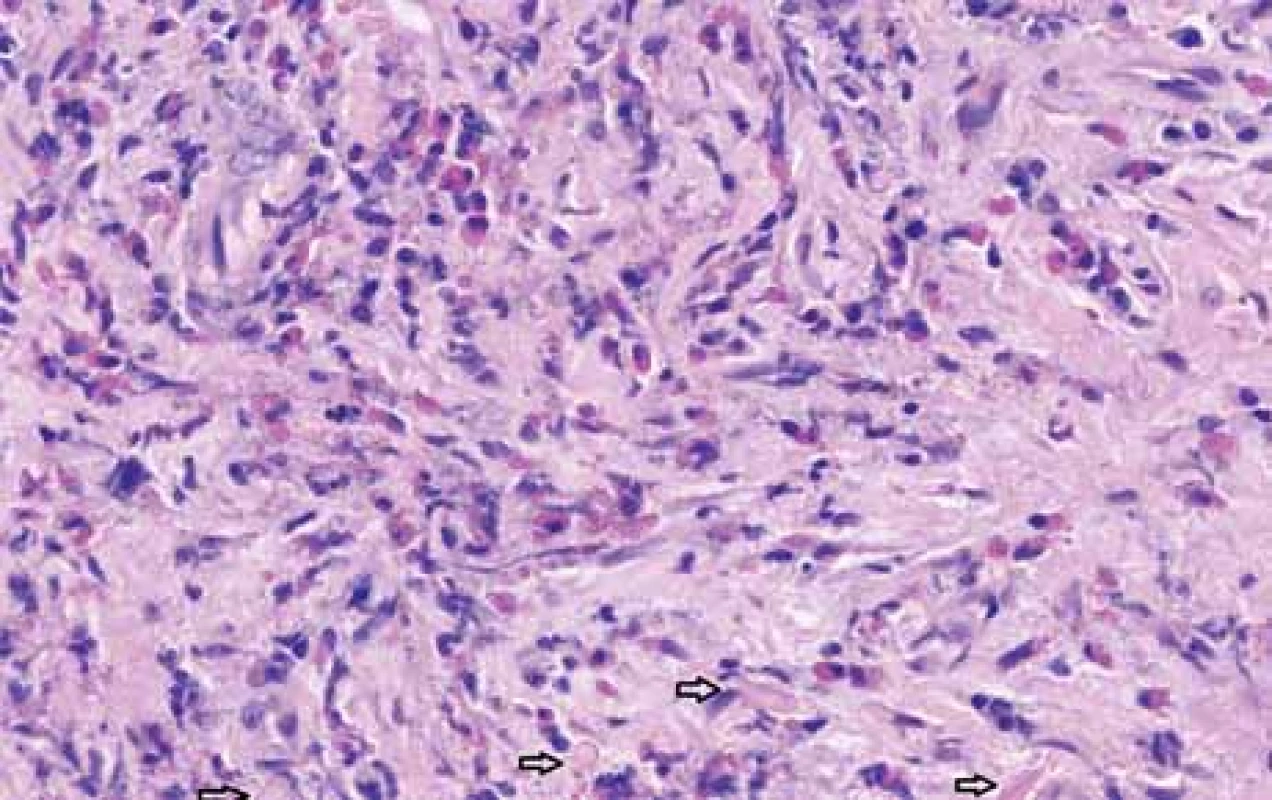 Full thickness biopsy of duodenum, sheets of degranulated eosinophils
in deep duodenal wall, Charcot-Leyden crystals (arrows), hematoxylin and
eosin stain, magnifi cation 100×.<br>
Obr. 3. Histopatologické vyšetření incize stěny duodena ukazuje v hlubokých vrstvách degranulované eozinofi ly a Charcot-Leydenovy krystaly (šipky), barvení hematoxylin-eosinem, zvětšení 100×.
