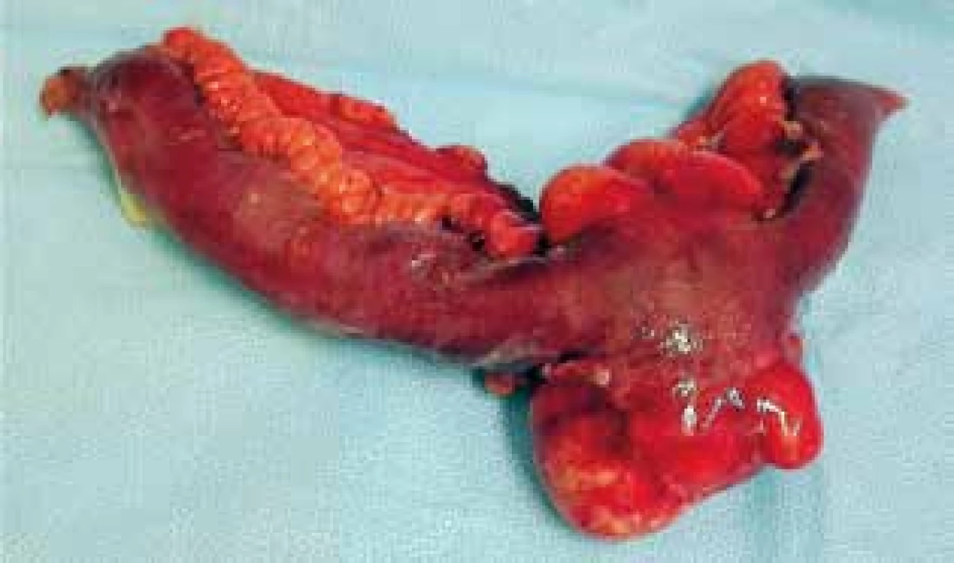 Resekát ilea s abscesem<br>
Fig. 2: Small bowel specimen with the abscess 