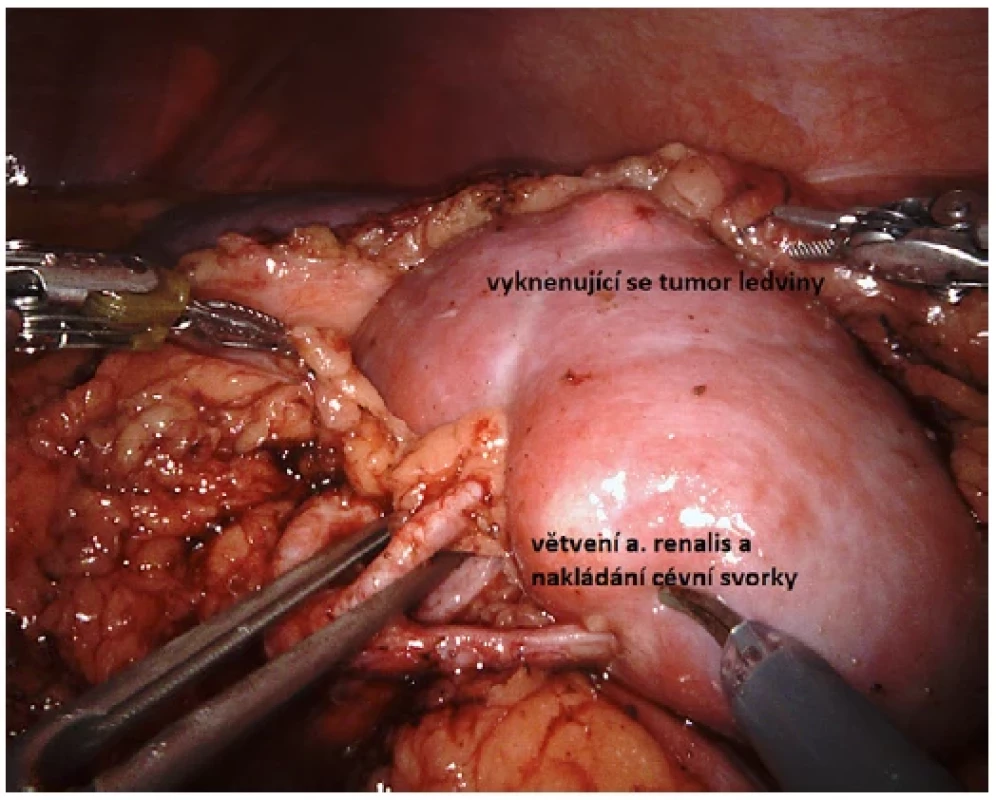 Tumor středního pólu ledviny a selektivní nakládání cévní svorky <br> 
Fig. 3. Middle pole tumor of the kidney and selective placement of the vascular clamp