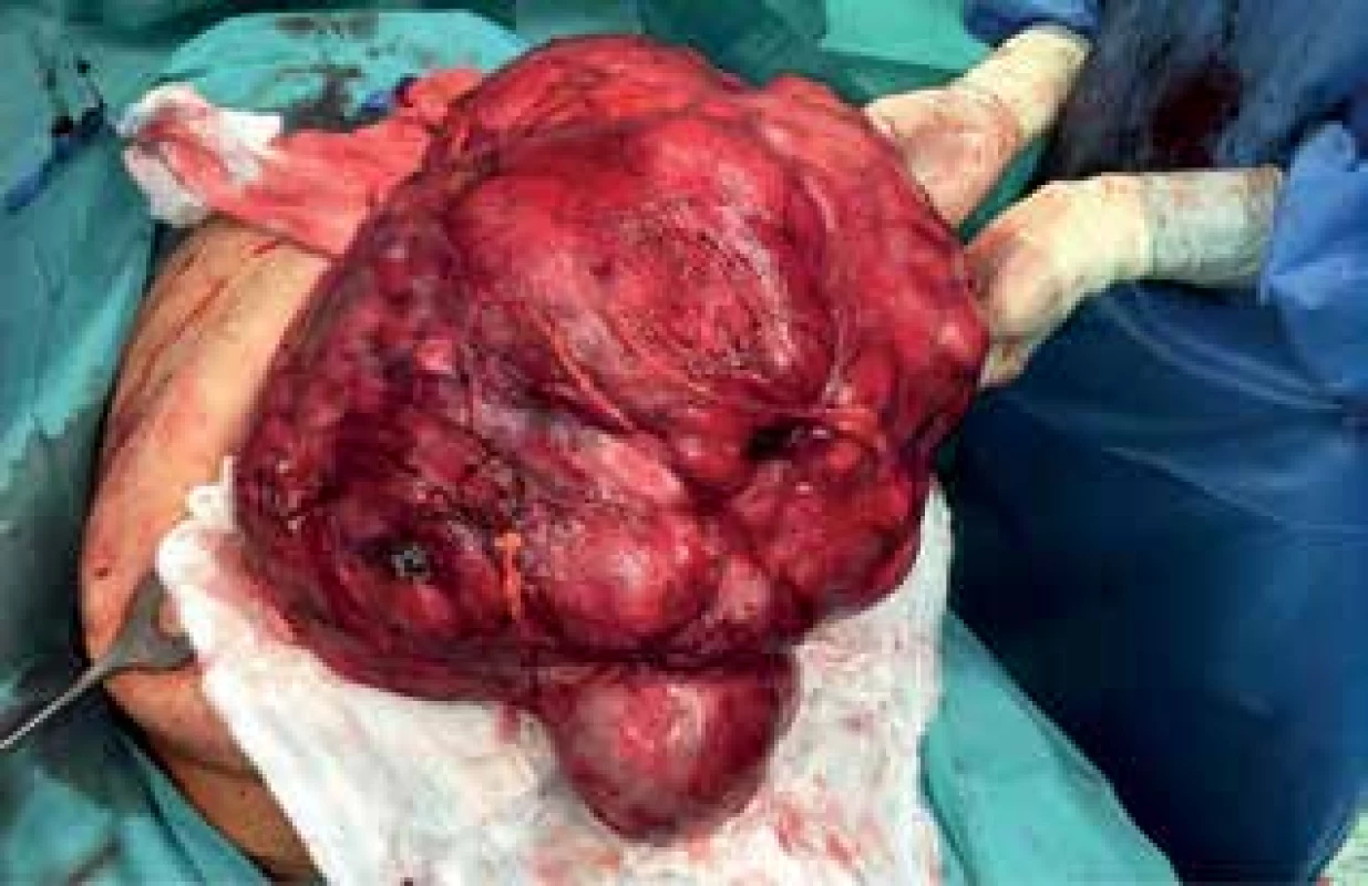 Peroperační nález II (liposarkom)<br>
Fig. 12: Peroperative finding II (liposarcoma)