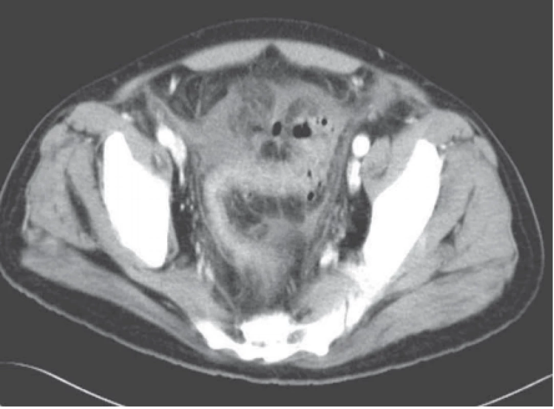 CT vyšetření břicha, axiální rovina (ze sonografi e komplikovaná divertikulitida colon sigmoideum). CT potvrzuje edematózní stěnu colon sigmoideum, četné divertikly, krytou perforaci, tekutinové lemy, toho času bez ohraničené kolekce tekutiny či jasného abscesu.<br>
Fig. 9. CT examination of the abdomen, in the axial plane (from a sonograph of
complicated diverticulitis of the sigmoid colon). The CT confi rms the edematous
wall of the sigmoid colon, numerous diverticula, a covered perforation, fl uid margins, at that time without a contained collection of fluid or obvious abscess.