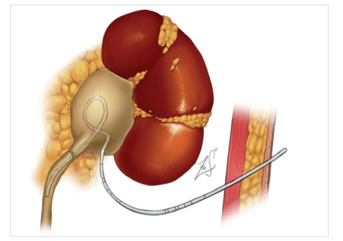 Transanastomotická ureteropyelostomie po robotické pyeloplastice<br>
Fig. 1: Transanastomotic uretro-pyelostomy after robotic pyeloplasty