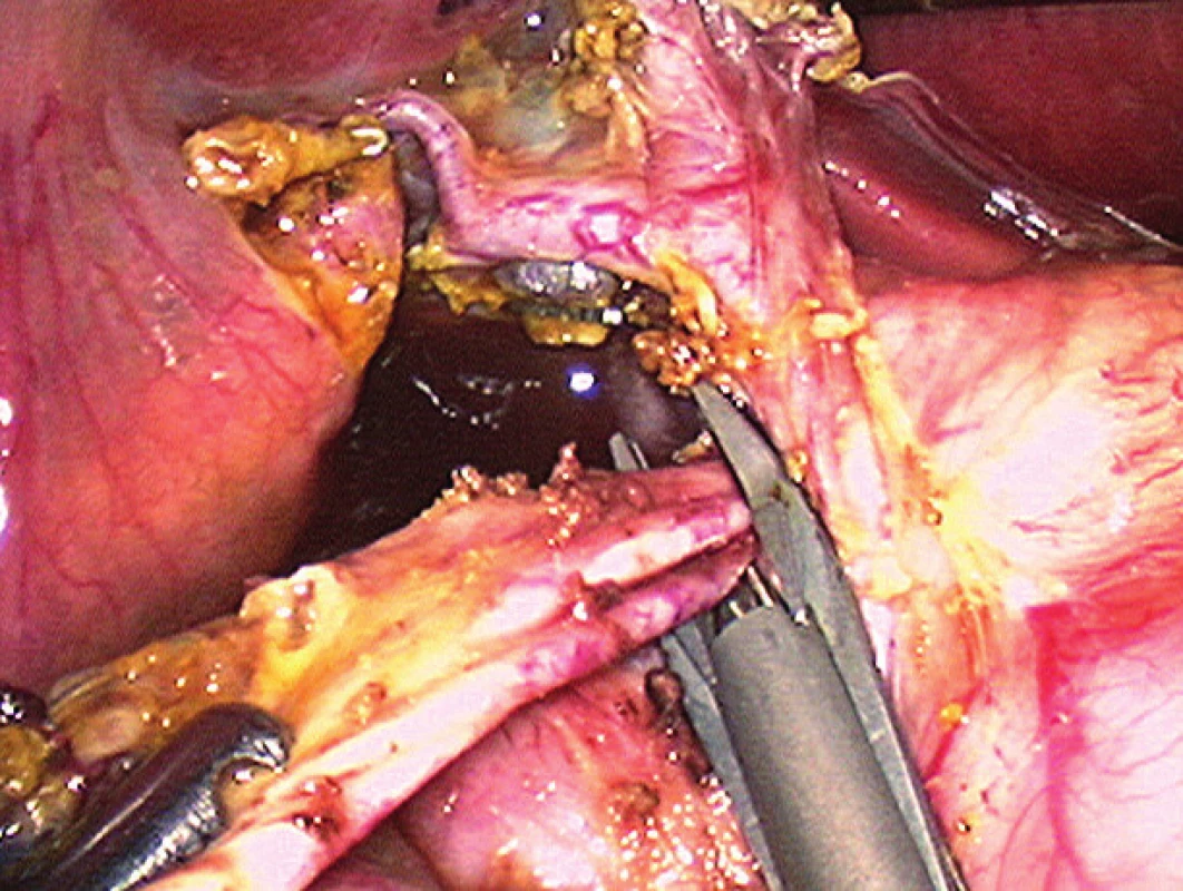 Laparoskopická operácia cystickej malformácie žlčových
ciest.<br>
Fig. 8. Laparoscopic treatment of congental choledochal cyst,