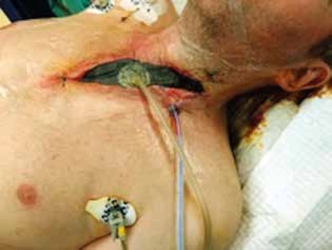 V.A.C systém pri dehiscencii na krku (vlastný archív)<br>
Fig. 4: V.A.C system applied in anastomotic dehiscence of
neck area (custome archive)